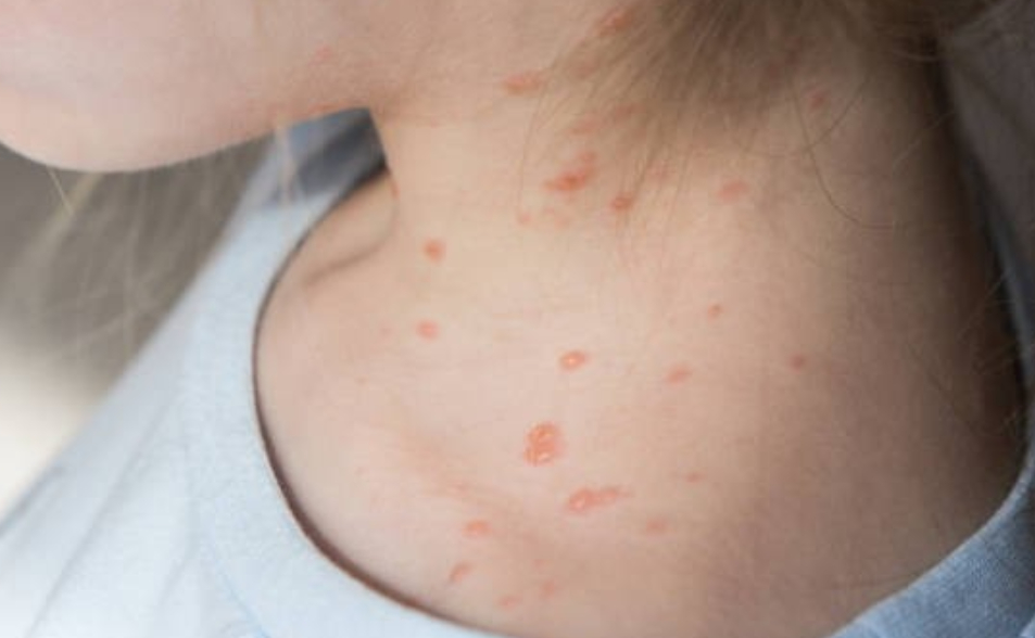 南港高中爆水痘疫情！學生轟校方「怕麻煩不想停課」　北市衛生局回應了